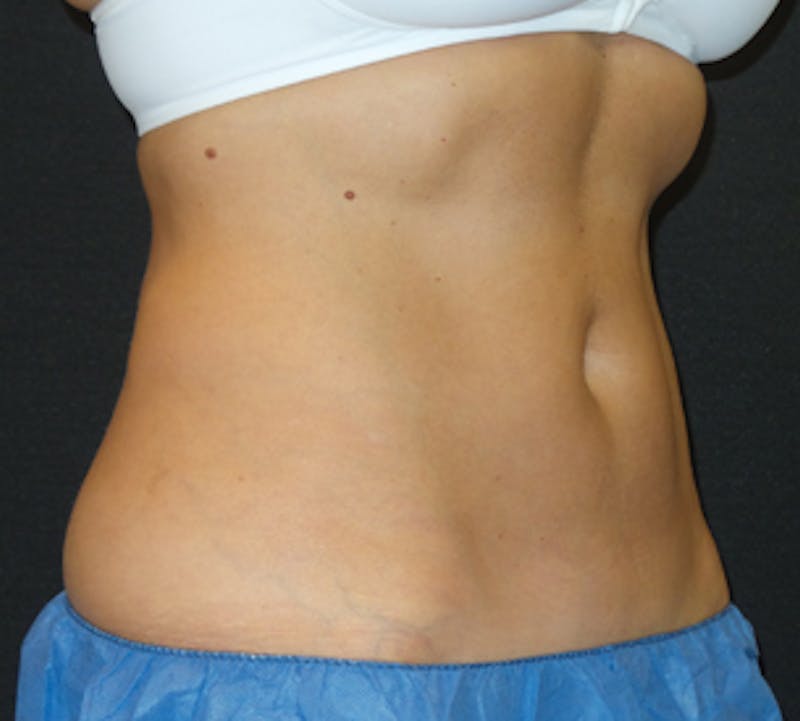 CoolSculpting® Gallery - Patient 106986113 - Image 8