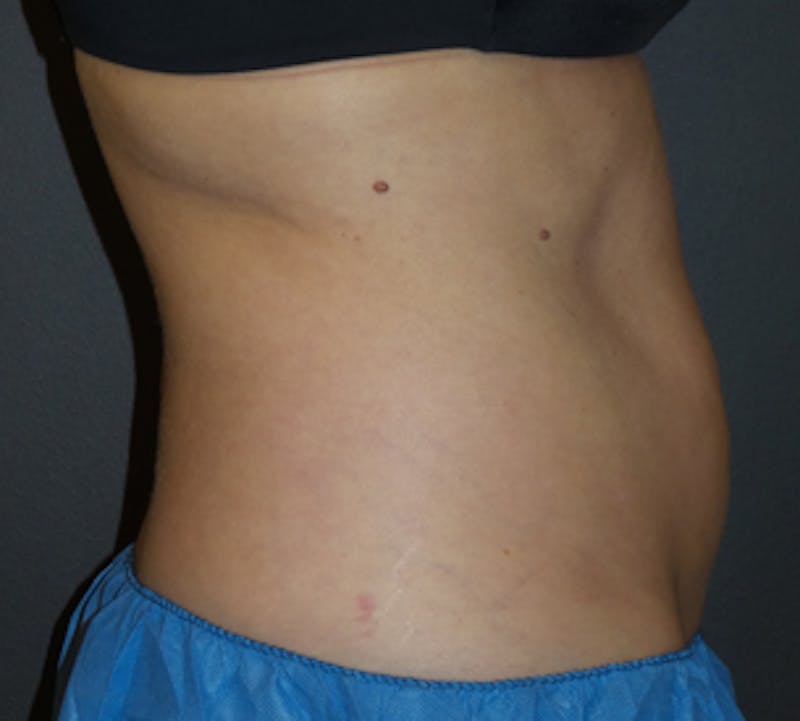 CoolSculpting® Before & After Gallery - Patient 106986113 - Image 9