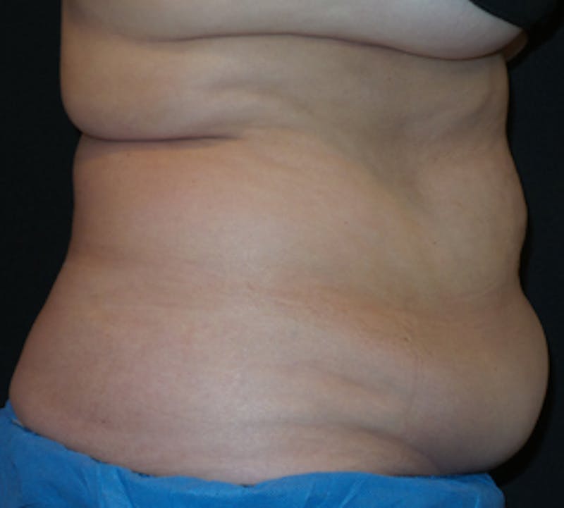 CoolSculpting® Before & After Gallery - Patient 106986117 - Image 1