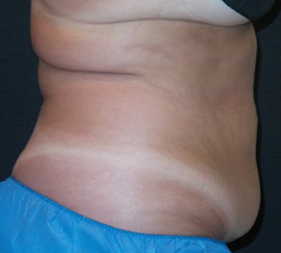 CoolSculpting® Before & After Gallery - Patient 106986117 - Image 2