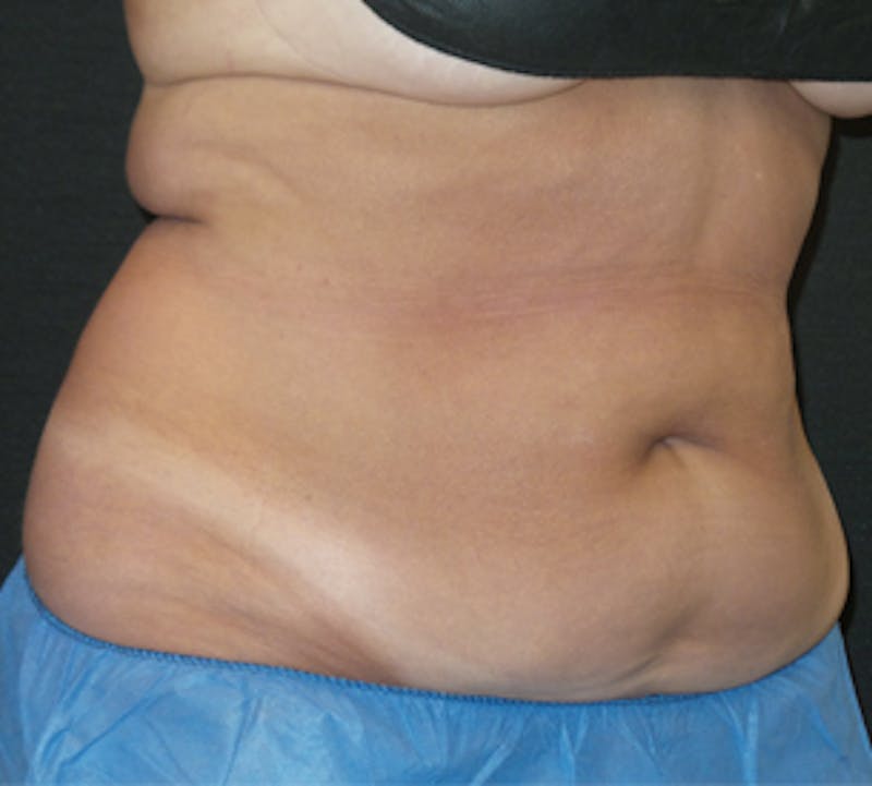 CoolSculpting® Gallery - Patient 106986117 - Image 4