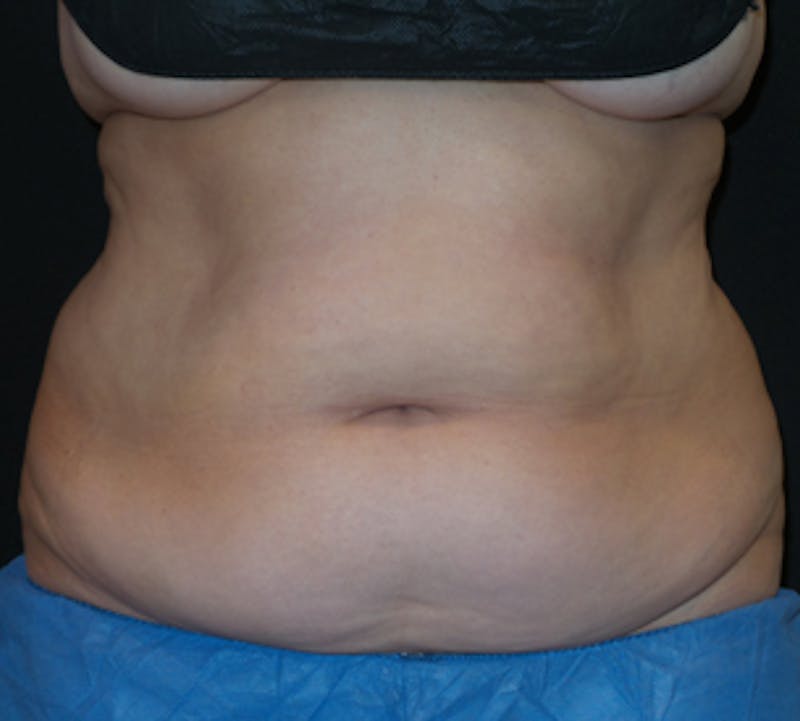 CoolSculpting® Before & After Gallery - Patient 106986117 - Image 5
