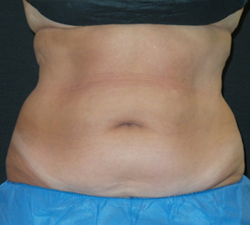 CoolSculpting® Gallery - Patient 106986117 - Image 6