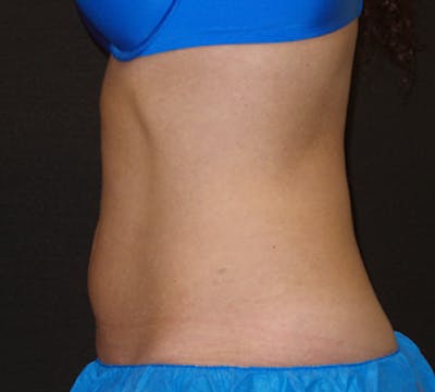 CoolSculpting® Before & After Gallery - Patient 106986135 - Image 2