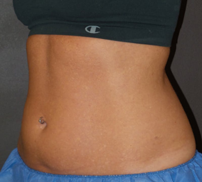 CoolSculpting® Gallery - Patient 106986135 - Image 3