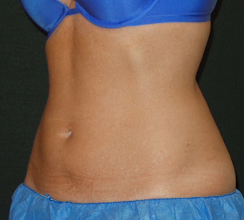CoolSculpting® Before & After Gallery - Patient 106986135 - Image 4