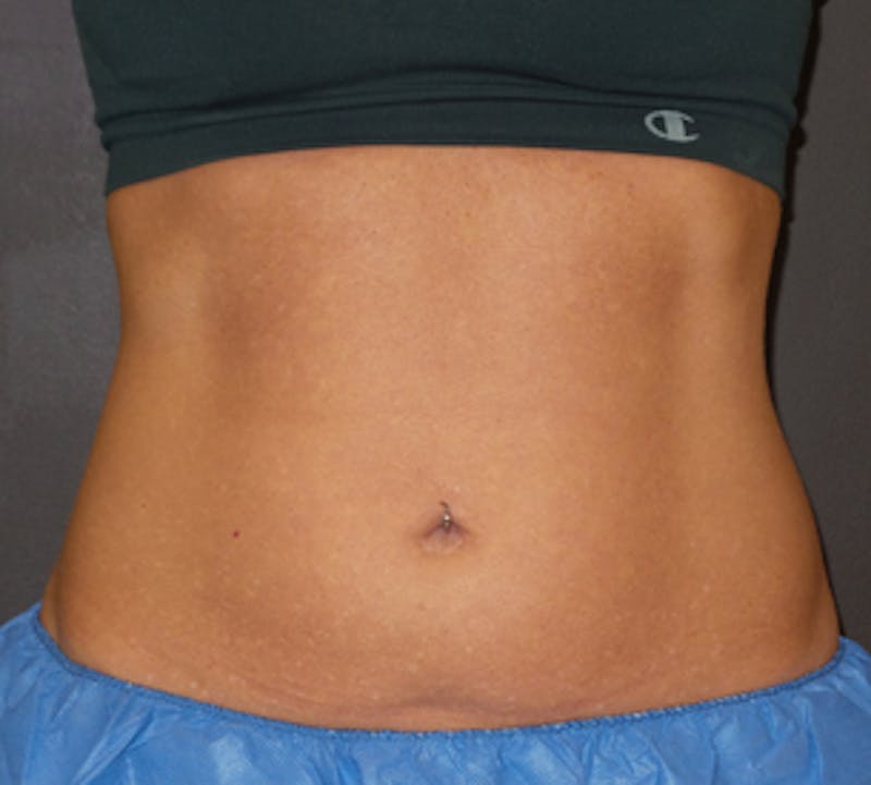 CoolSculpting® Before & After Gallery - Patient 106986135 - Image 5
