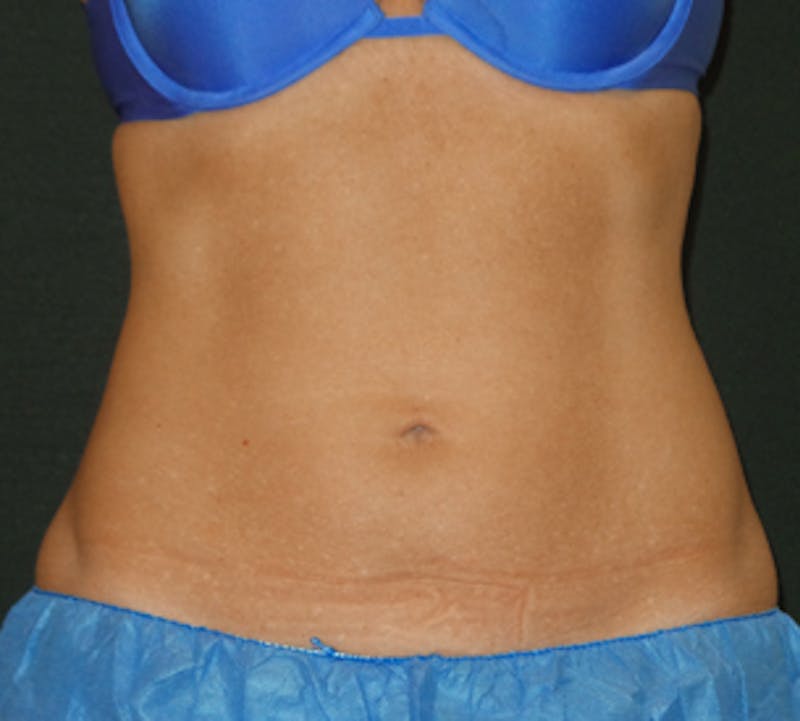 CoolSculpting® Before & After Gallery - Patient 106986135 - Image 6