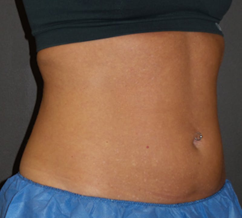 CoolSculpting® Before & After Gallery - Patient 106986135 - Image 7