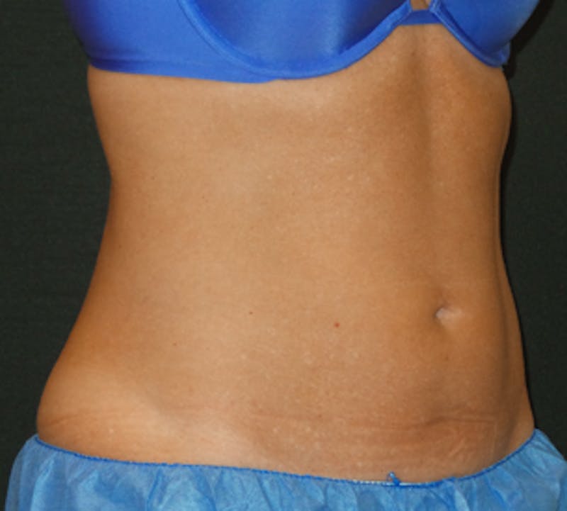 CoolSculpting® Before & After Gallery - Patient 106986135 - Image 8