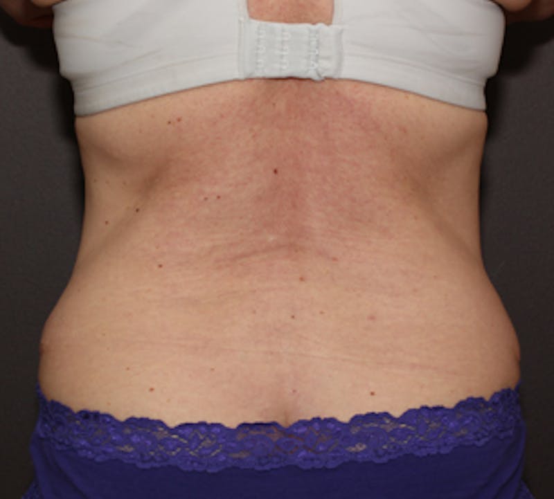 CoolSculpting® Gallery - Patient 106986137 - Image 1