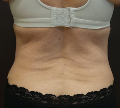 CoolSculpting® Before & After Gallery - Patient 106986137 - Image 2