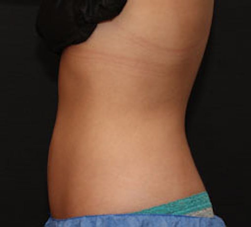 CoolSculpting® Before & After Gallery - Patient 106986140 - Image 2