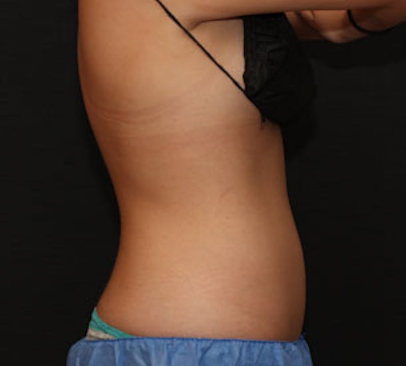 CoolSculpting® Before & After Gallery - Patient 106986140 - Image 4