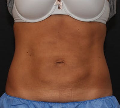 CoolSculpting® Before & After Gallery - Patient 106986144 - Image 2