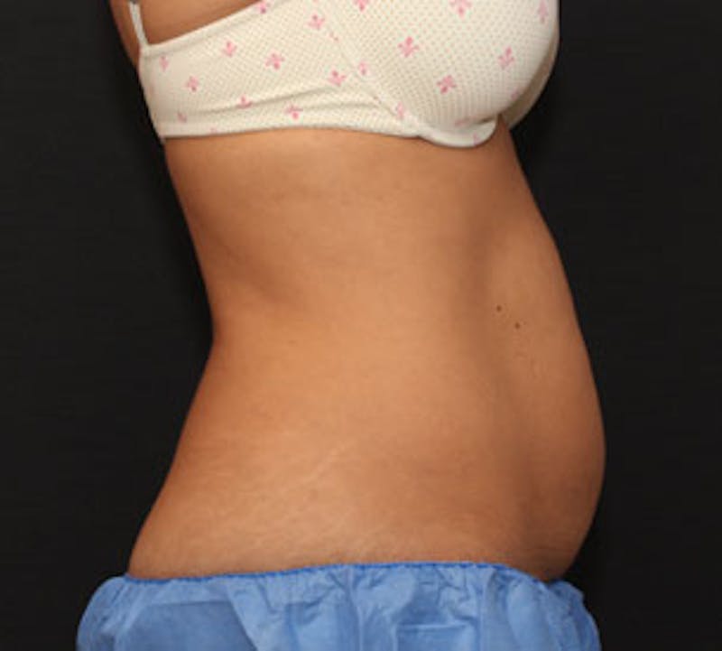 CoolSculpting® Before & After Gallery - Patient 106986144 - Image 3