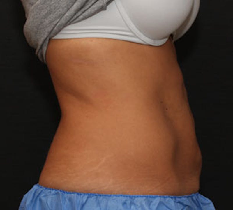 CoolSculpting® Gallery - Patient 106986144 - Image 4