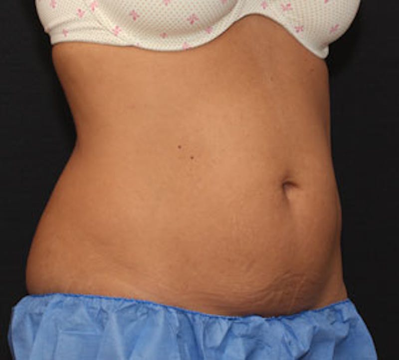 CoolSculpting® Before & After Gallery - Patient 106986144 - Image 5