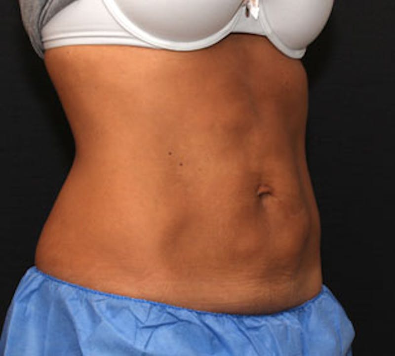 CoolSculpting® Before & After Gallery - Patient 106986144 - Image 6