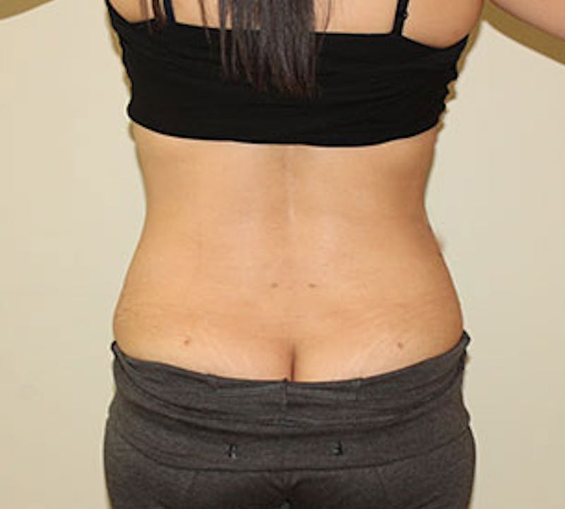 Liposuction Before & After Gallery - Patient 106986632 - Image 2