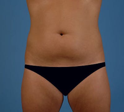 Liposuction Before & After Gallery - Patient 106986637 - Image 1