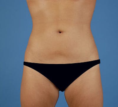 Liposuction Before & After Gallery - Patient 106986637 - Image 2