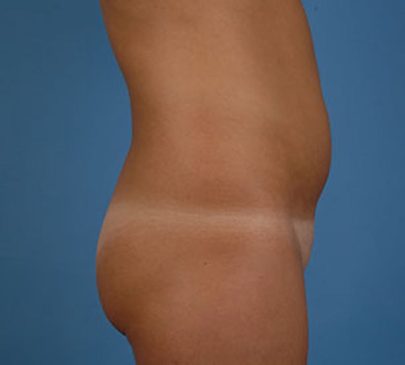 Liposuction Before & After Gallery - Patient 106986637 - Image 3