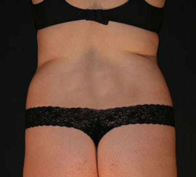 Liposuction Before & After Gallery - Patient 106986641 - Image 1