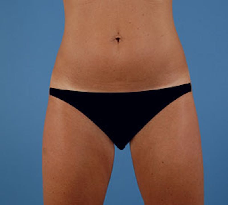 Liposuction Before & After Gallery - Patient 106986648 - Image 2