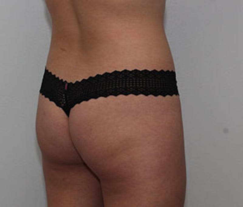 Brazilian Butt Lift Before & After Gallery - Patient 106998738 - Image 3