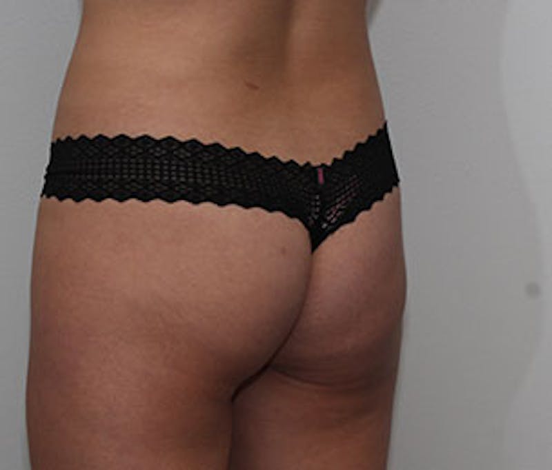 Brazilian Butt Lift Before & After Gallery - Patient 106998738 - Image 7