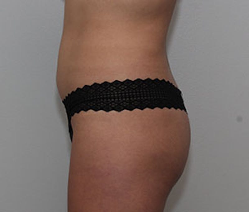 Brazilian Butt Lift Before & After Gallery - Patient 106998738 - Image 9