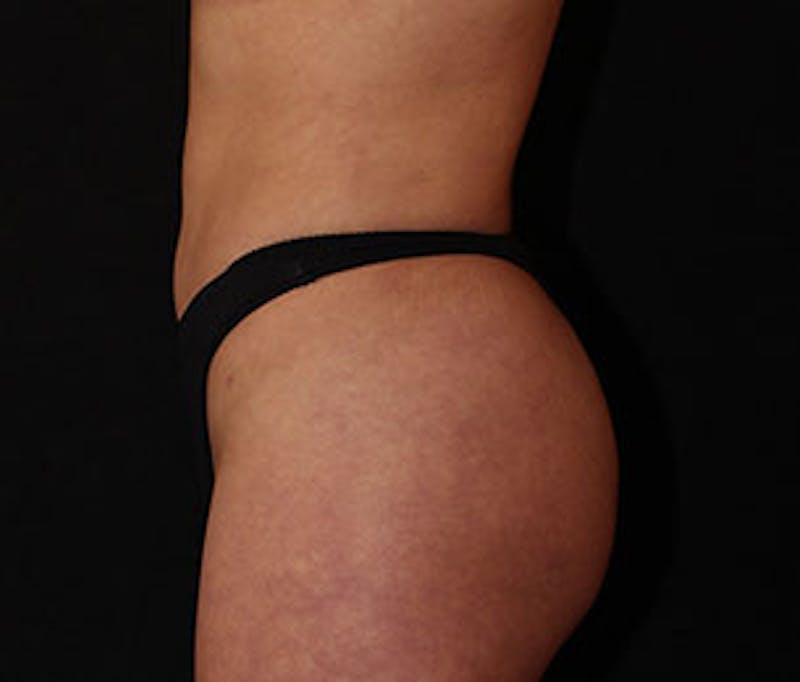 Brazilian Butt Lift Before & After Gallery - Patient 106998738 - Image 10