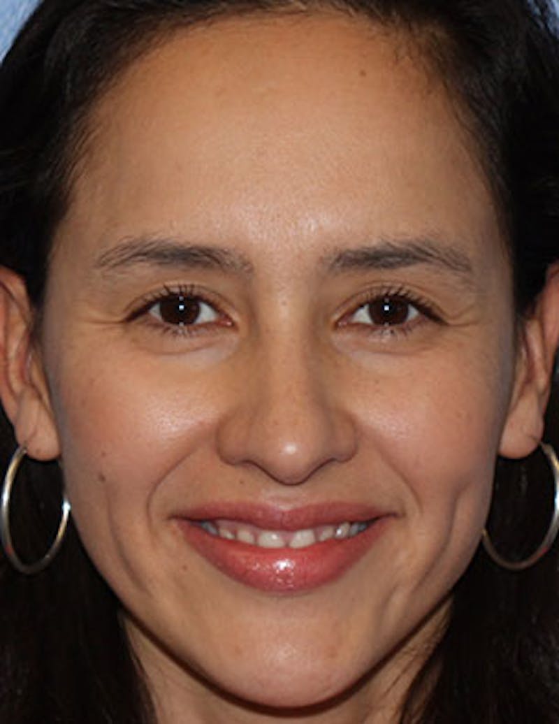 Botox® Dysport® Before & After Gallery - Patient 106999421 - Image 3