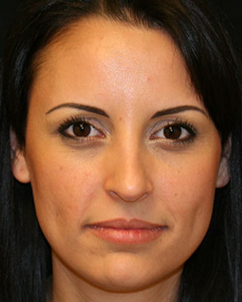 Botox® Dysport® Before & After Gallery - Patient 106999424 - Image 1