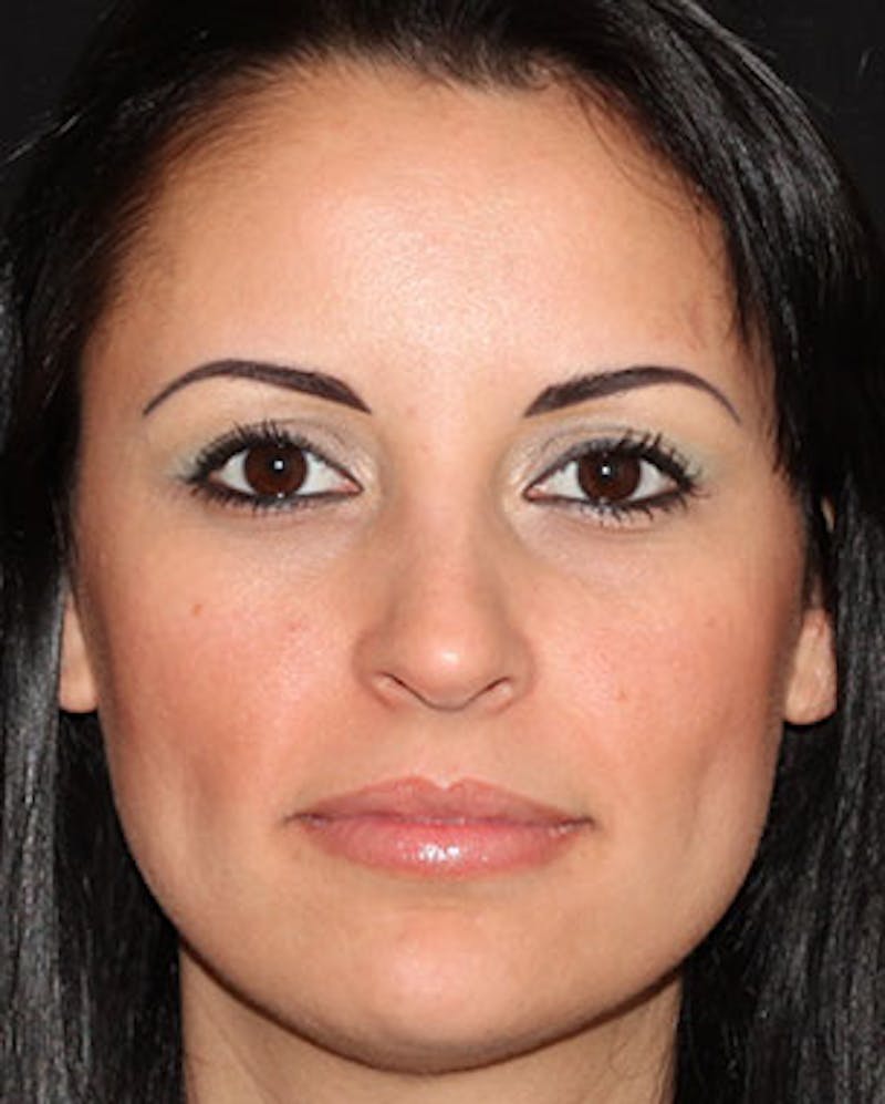 Botox® Dysport® Before & After Gallery - Patient 106999424 - Image 2