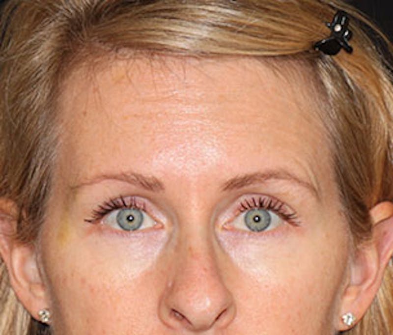 Botox® Dysport® Before & After Gallery - Patient 106999425 - Image 6