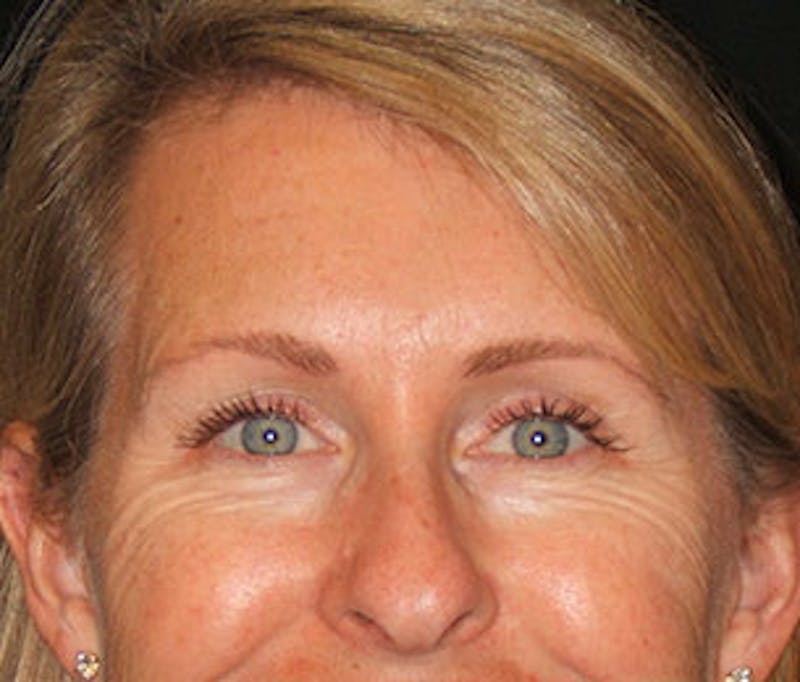 Botox® Dysport® Before & After Gallery - Patient 106999425 - Image 7