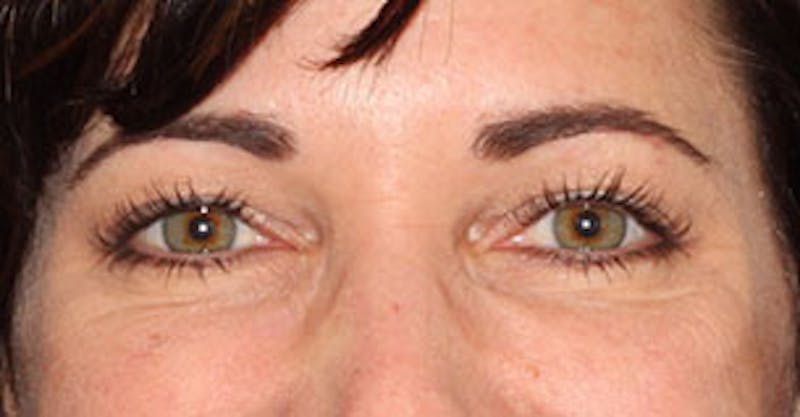 Botox® Dysport® Before & After Gallery - Patient 106999443 - Image 4