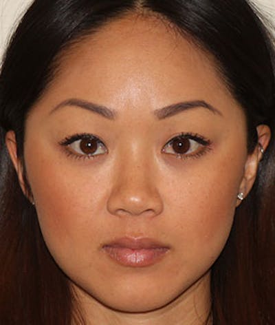 Botox® Dysport® Before & After Gallery - Patient 106999446 - Image 2