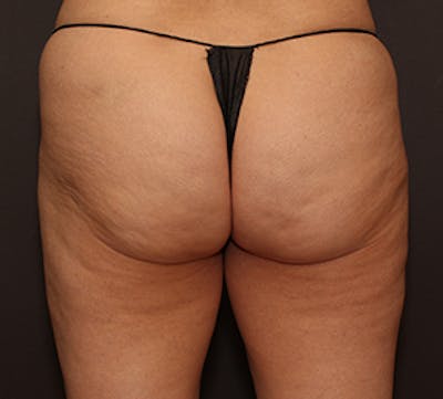 Cellfina™ Before & After Gallery - Patient 106999844 - Image 1
