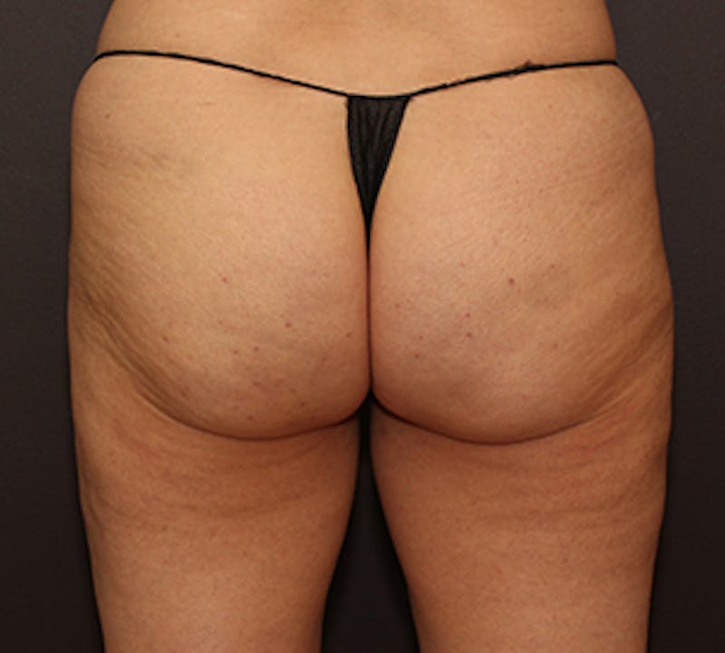 Cellfina™ Before & After Gallery - Patient 106999844 - Image 2