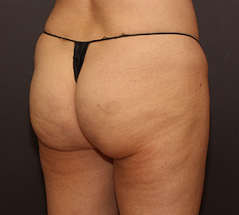 Cellfina™ Before & After Gallery - Patient 106999844 - Image 4