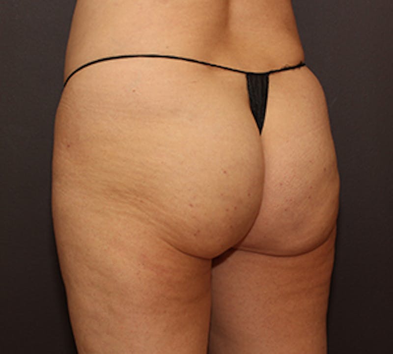 Cellfina™ Before & After Gallery - Patient 106999844 - Image 6