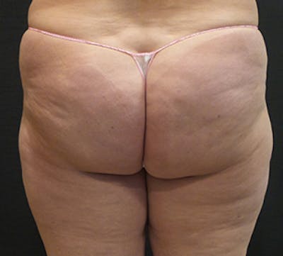 Cellfina™ Before & After Gallery - Patient 106999857 - Image 2