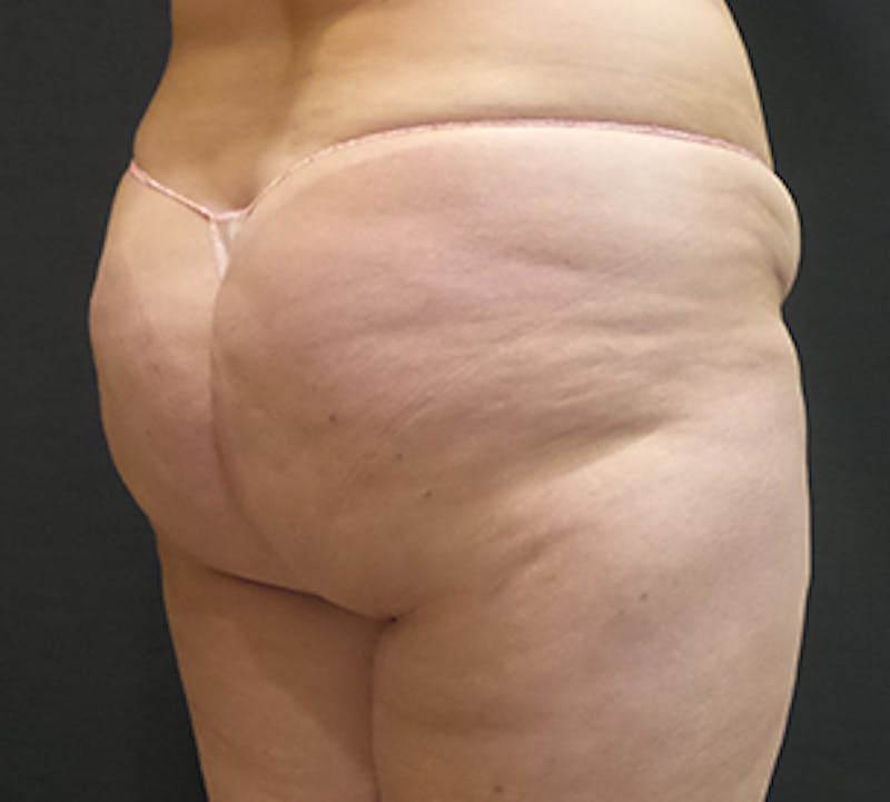 Cellfina™ Before & After Gallery - Patient 106999857 - Image 4