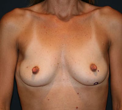 Breast Reconstruction Before & After Gallery - Patient 107001368 - Image 1