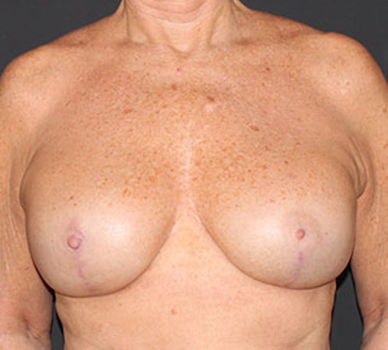 Breast Reconstruction Before & After Gallery - Patient 107001372 - Image 2