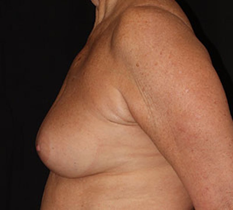 Breast Reconstruction Before & After Gallery - Patient 107001372 - Image 9