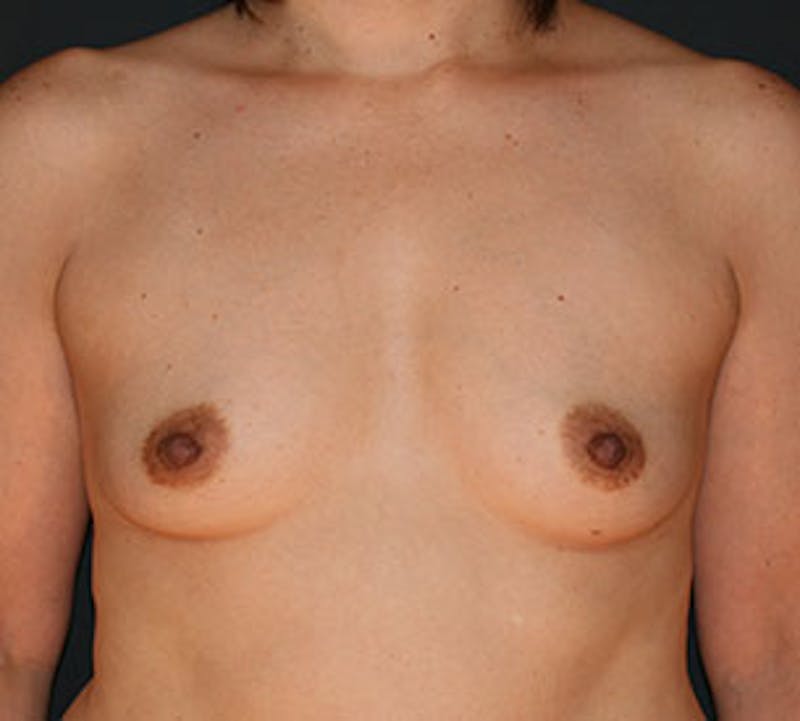 Breast Reconstruction Before & After Gallery - Patient 107001375 - Image 1